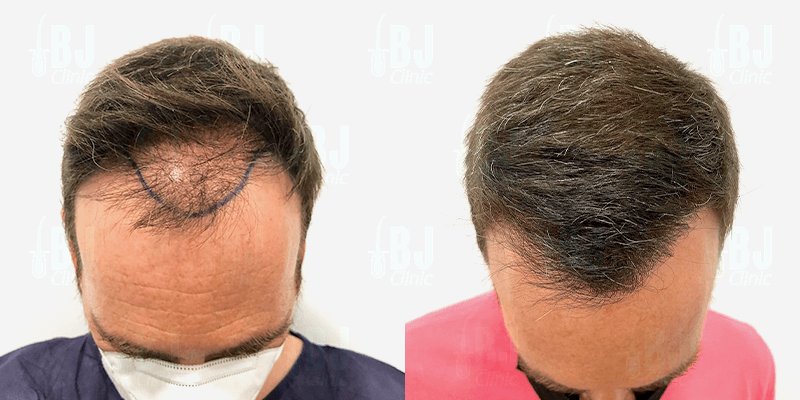 resultados injerto capilar  - Top diez mitos sobre el injerto capilar desmentidos - uve medical, clinica de estetica capilar y facial