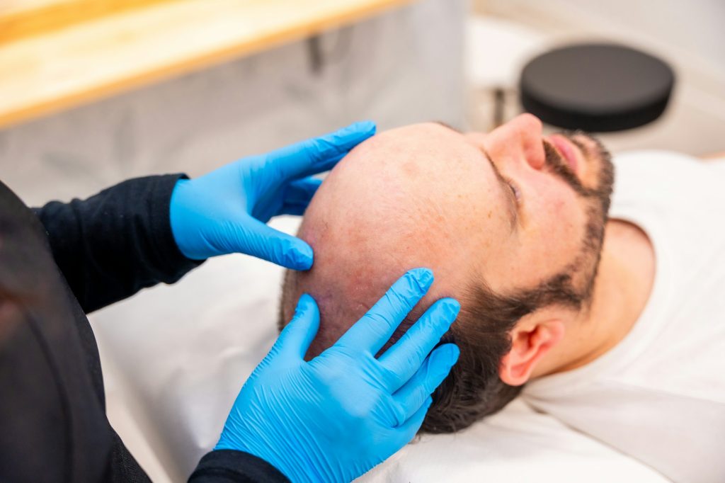 Doctor specialist in baldness checking a patient with hair loss  - Top diez mitos sobre el injerto capilar desmentidos - uve medical, clinica de estetica capilar y facial