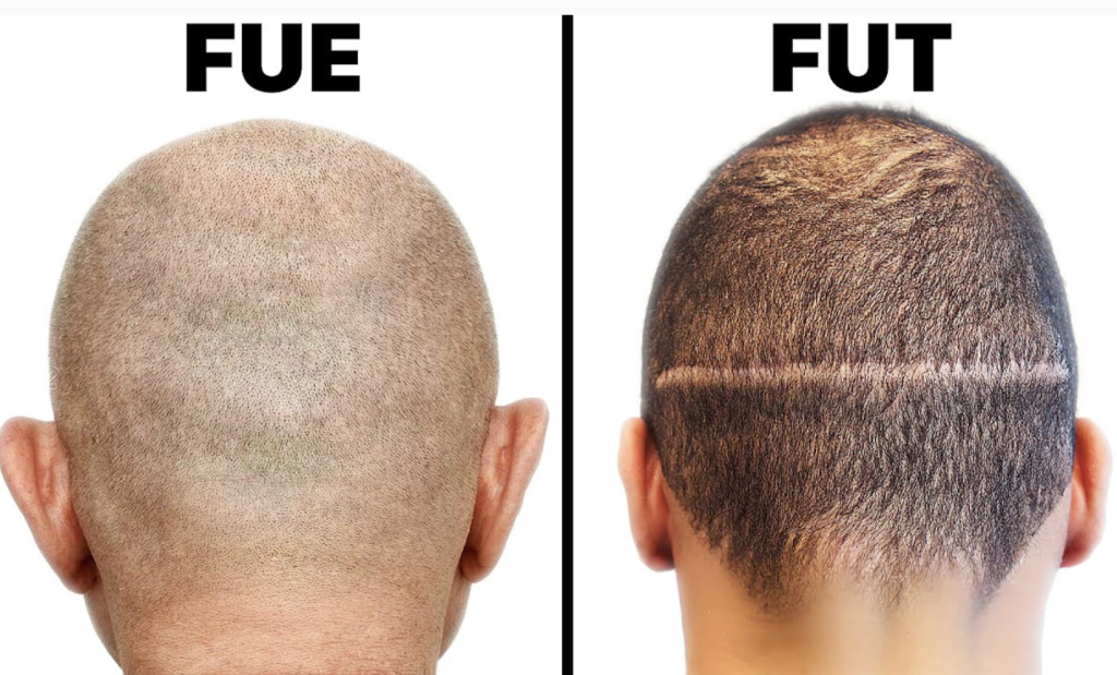 Foto técnicas fue y fut --¿Cuáles son las Diferencias entre el Trasplante de Pelo para Hombres y Mujeres? - UVEMedical, clínica de injerto capilar y tratamientos estéticos