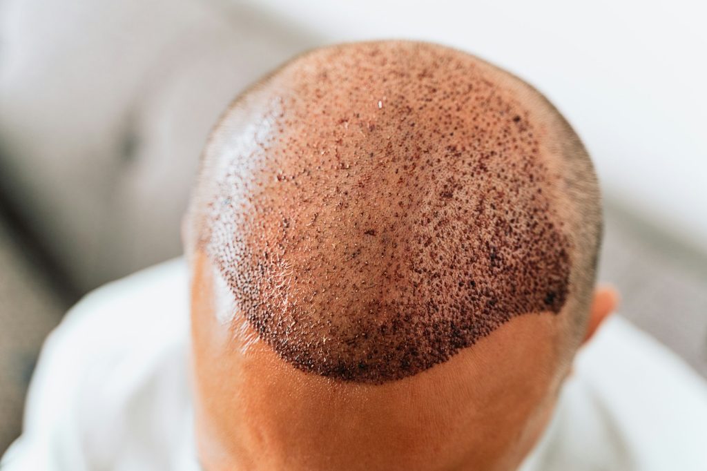 hair transplantation surgical-¿Es Posible Realizar un Injerto Capilar sin Rapar el Cabello?-UVEMedical, ser una clinica pionera en injertis capilares y otros tratamientos esteticos
