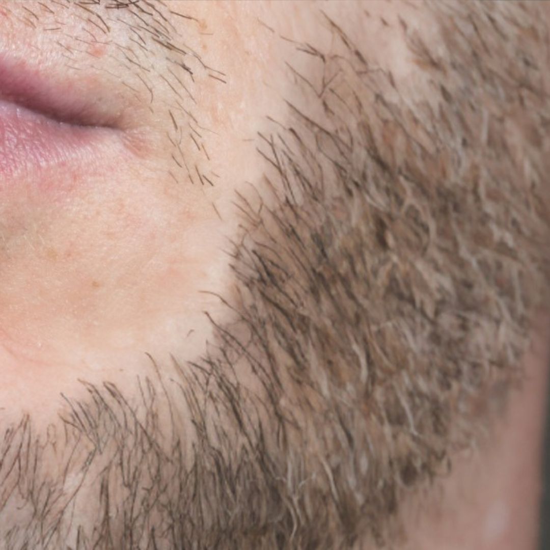 Despues de injerto de barba