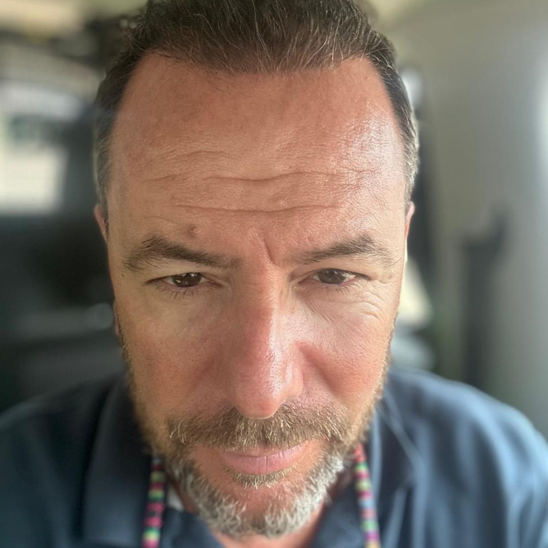 Antes y después de injerto capilar en Madrid