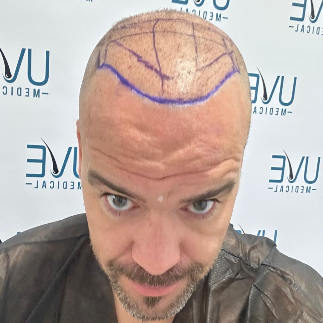 Equipo médico especialista en injerto capilar en Madrid